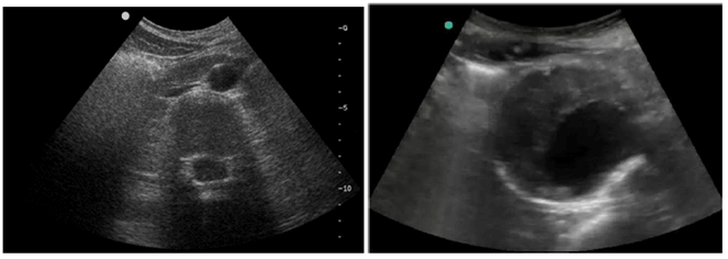 Copy of original 3GPP image for 3GPP TS 22.826, Figure 5.3.2.1-1: Ultra-sound imagery of an abdominal aortic aneurysm (right hand side picture)